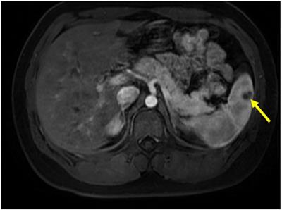 Case Report: Reflection on a case of splenic abscess in a child